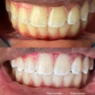 Classes for PerfectedSmile